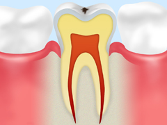 C0【ごく初期の虫歯】