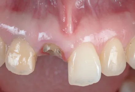 セラミック症例1before
