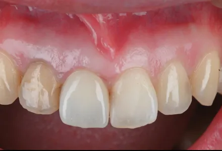 セラミック症例1after