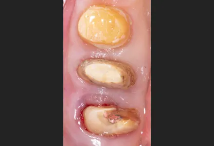 セラミック症例2before