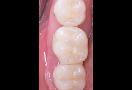 セラミック症例2after