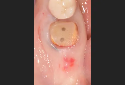 インプラント症例1before