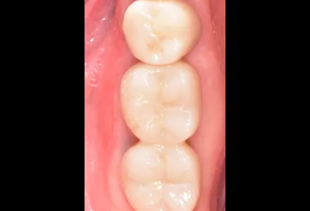 インプラント症例1after