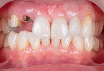 インプラント症例2before