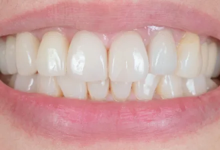 インプラント症例2after