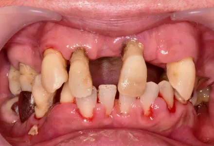 全顎治療症例1before