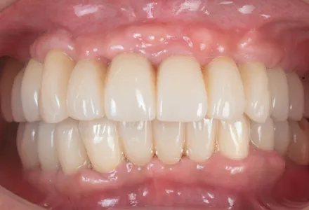 全顎治療症例1after