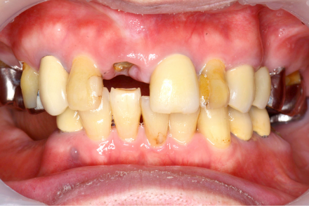 全顎治療症例2before